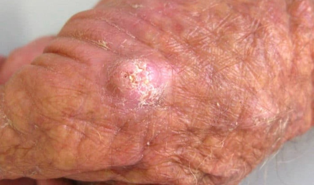 Carcinoma espinocelular