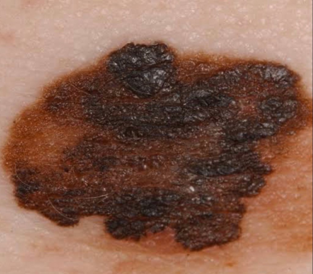 Melanoma