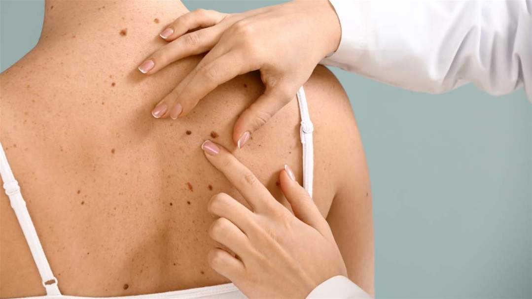 Câncer de pele – sinais de alerta