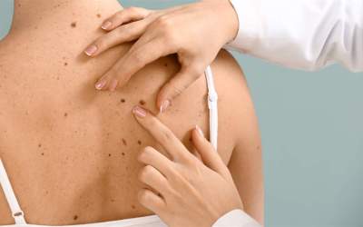 Câncer de pele – sinais de alerta
